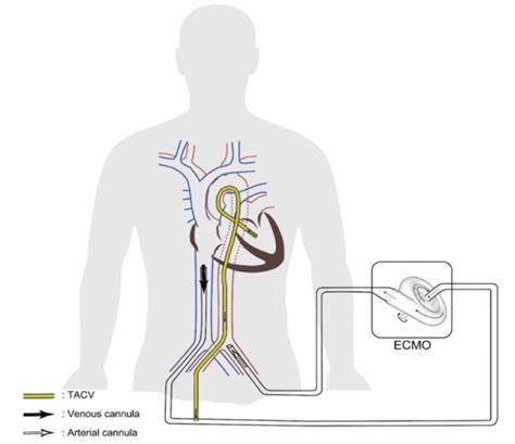 va ecmo Lv distention